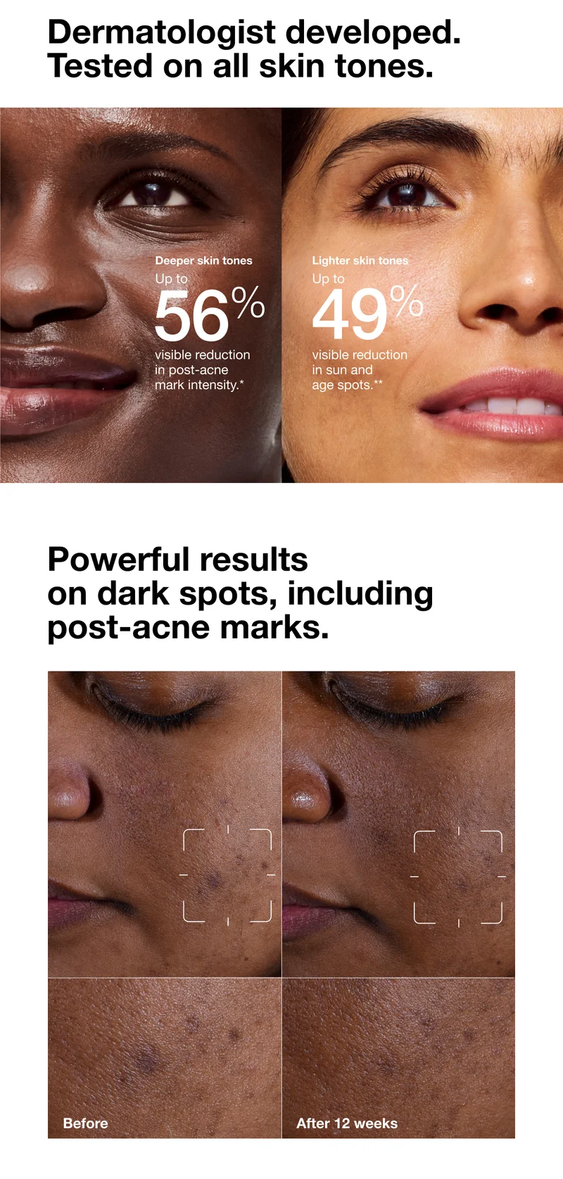 Dermatologist developed. Tested on all skin tones. | Deeper skin tones | Up to 56% visible reduction in post-acne mark intensity.* | Lighter skin tones | Up to 49% visible reduction in sun and age spots.** | Powerful results on dark spots, including post-acne marks. | Before | After 12 weeks
