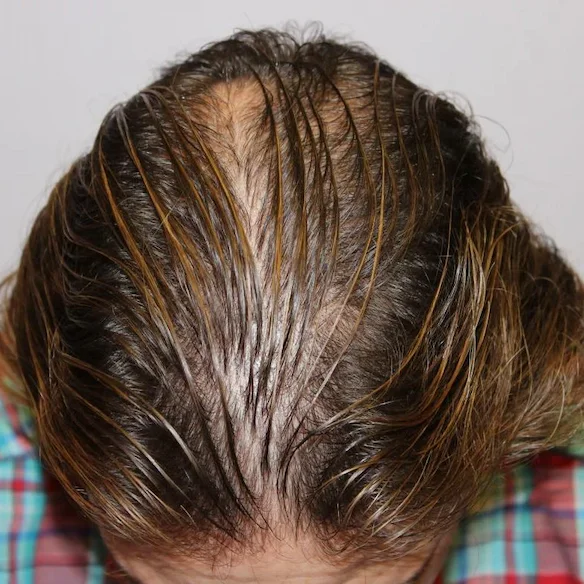 Early stage hair loss