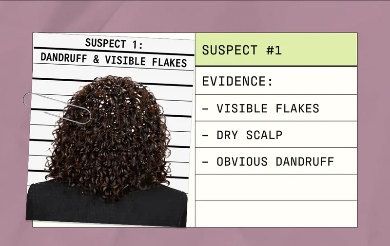 Suspect #1 | Evidence: Visible Flakes, Dry Scalp, Obvious Dandruff