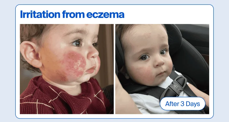 Before & after - irritation from eczema