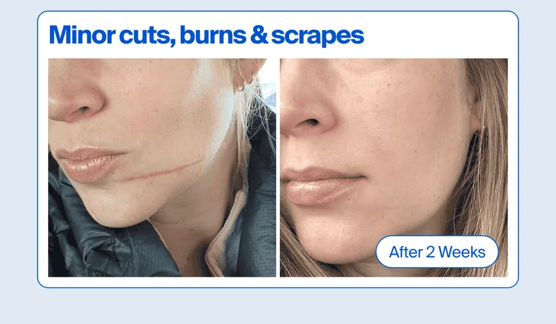 Before & after - minor cuts, burns & scrapes