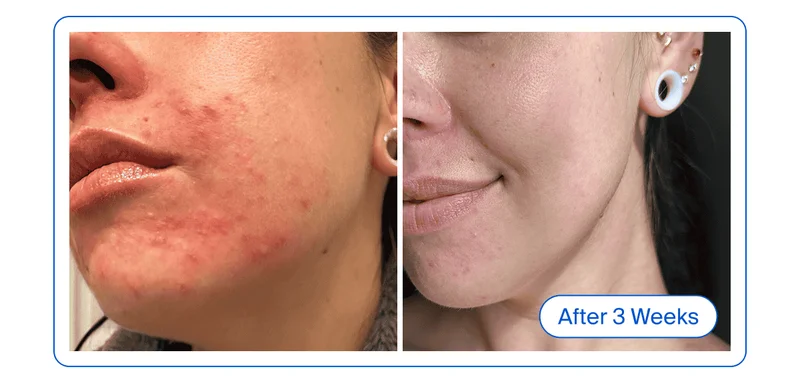 Before & After - Breakouts