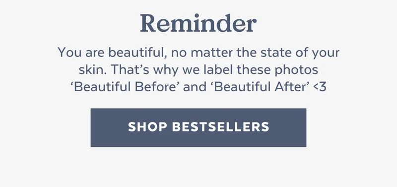 Reminder: You are beautiful, no matter the state of your skin. That’s why we label these photos ‘Beautiful Before’ and ‘Beautiful After’ <3 [SHOP BESTSELLERS]