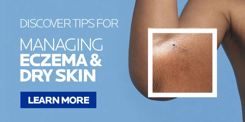 DISCOVER TIPS FOR MANAGING ECZEMA & DRY SKIN