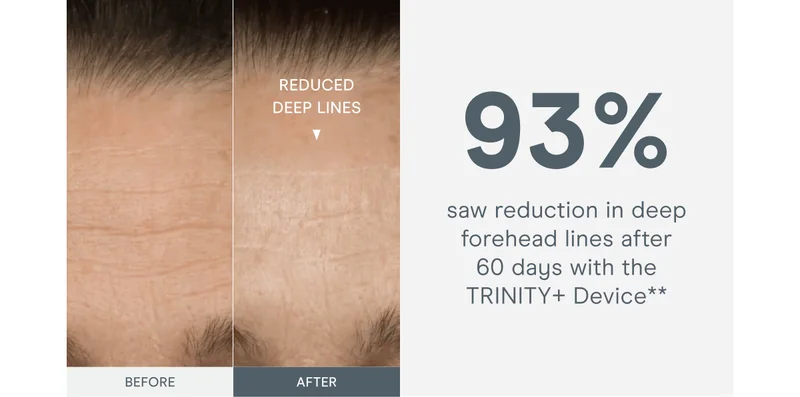 93% saw reduction in deep forehead lines after 60 days with the TRINITY+ Device**