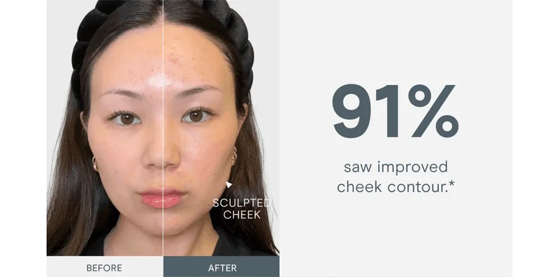 91% saw improved cheek contour.*