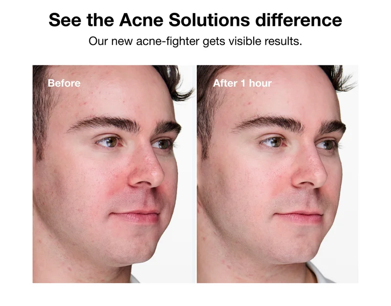 See the Acne Solutions difference | Our new acne-fighter gets visible results. | Before | After 1 hour