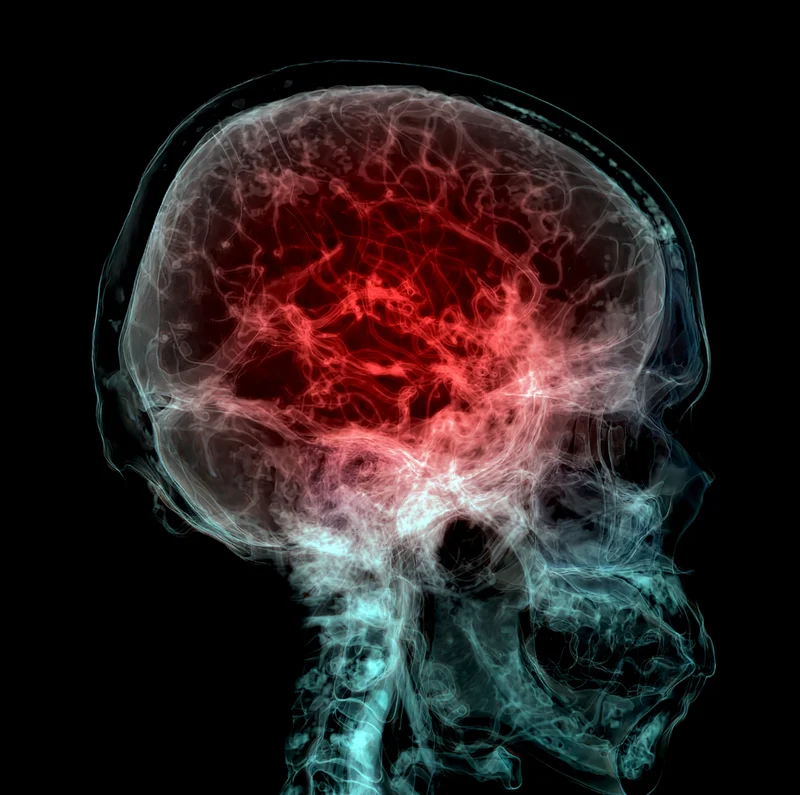 A colorized CT scan of the brain revealing blood vessels in the brain. A new study finds microplastics accumulate at higher levels in human brains than in the liver and kidneys.