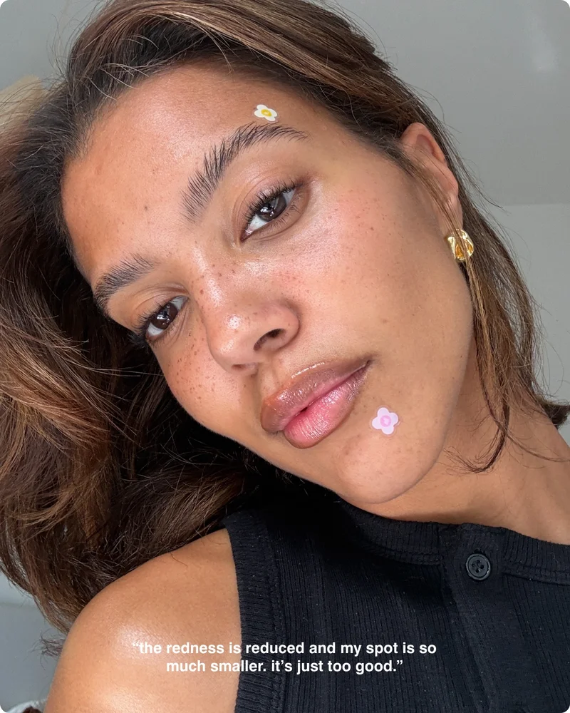 “The redness is reduced and my spot is so much smaller. It’s just too good.”
