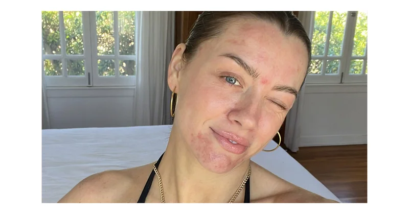 Adult Acne