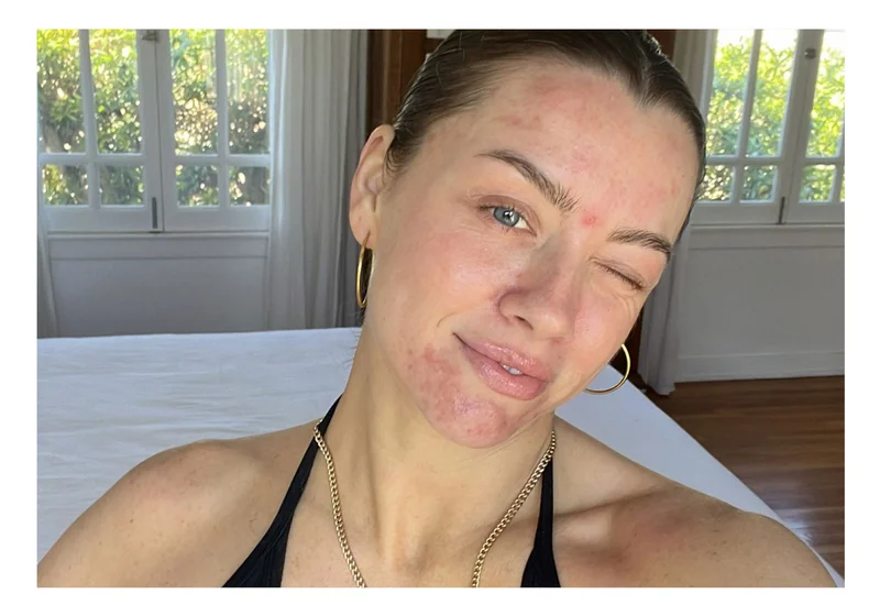 Adult Acne