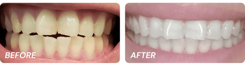 Before and After