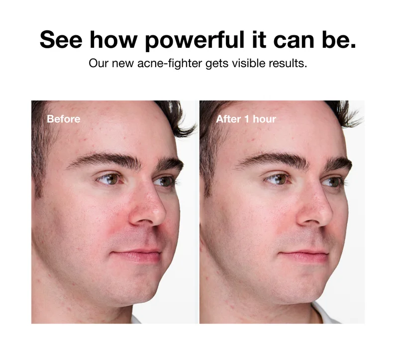 See how powerful it can be. | Our new acne-fighter gets visible results. | Before | After 1 hour