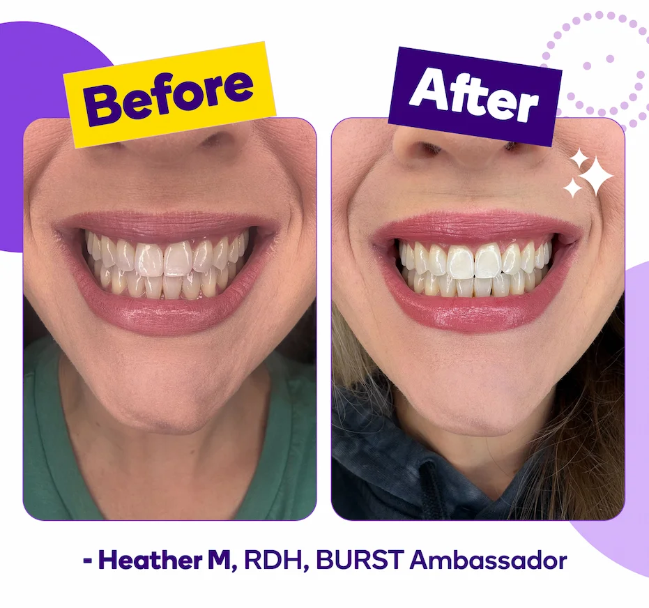 Prefilled Whitening Trays