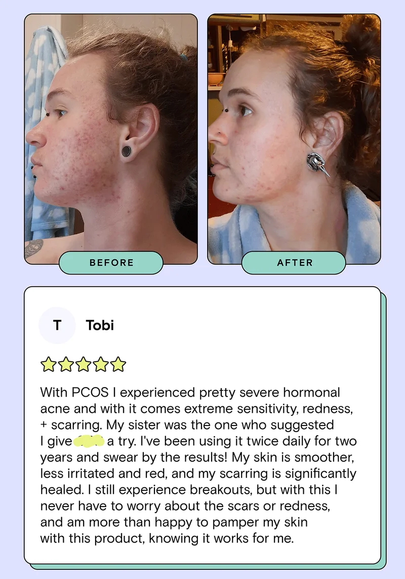 Guess which KB product Tobi's review is about: With PCOS I experienced pretty severe hormonal acne and with it come extreme sensitivity, redness, and scarring. My sister was the one who suggested I give [blank] a try. I've been using it twice daily for two years and swear by the results! My skin is smoother, less irritated and red, and my scarring significantly healed. I still experience breakouts, but with this I never have to worry about scars or redness, and am more than happy to pamper my skin with this product, knowing it works for me.