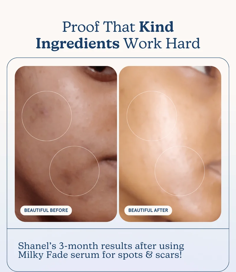 Proof That Kind Ingredients Work Hard | Shanel’s 3-month results after using Milky Fade!
