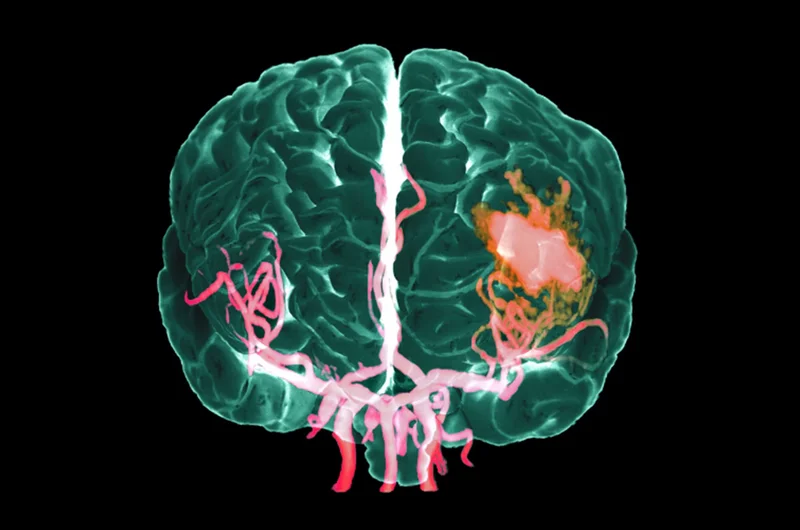 A colored three-dimensional MRA scan shows internal bleeding (red, center right) in a hemorrhagic stroke victim's brain (with arteries shown in pink). Recent research suggests stroke numbers are on the rise.