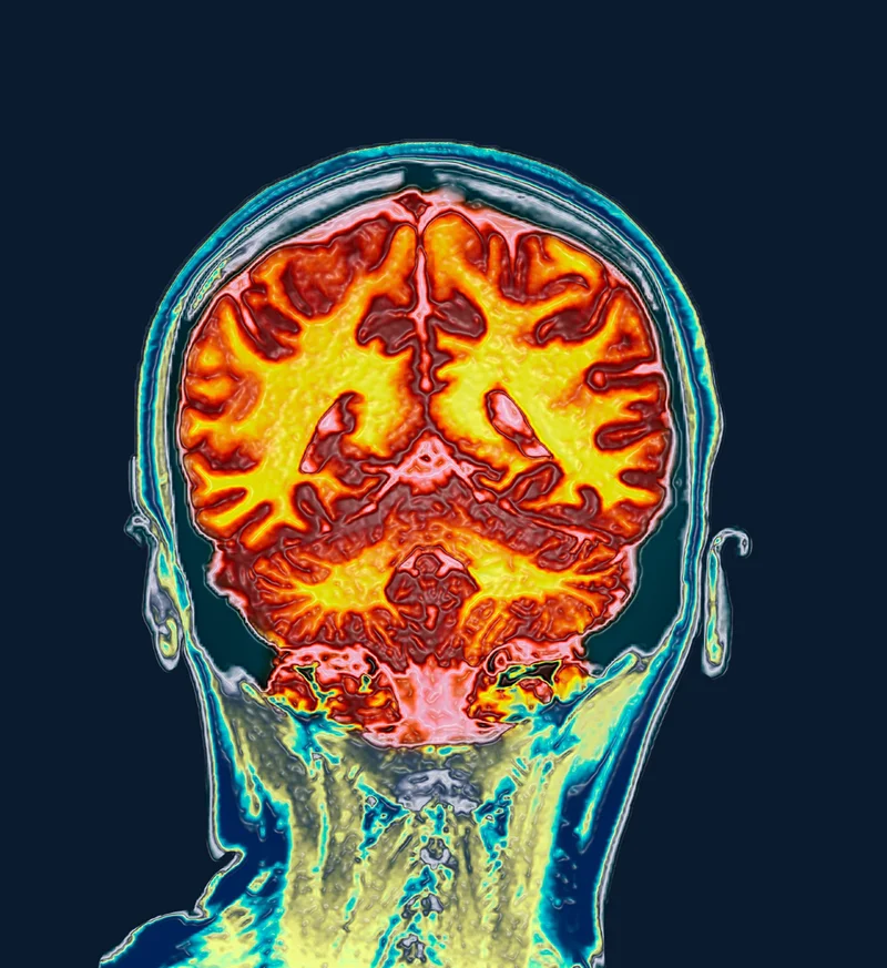 Colored coronal magnetic resonance imaging (MRI) scan of the brain of a healthy, premenopausal 32-year-old woman. A recent study in Nature Mental Health found that during the menstrual cycle, women experience changes in the volume of specific brain regions.