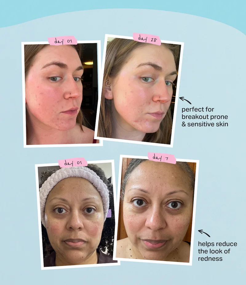 perfect for breakout prone  & sensitive skin