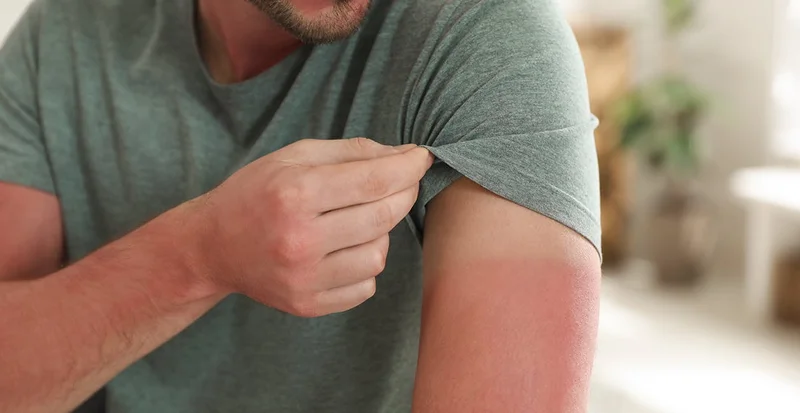 Sunburn recovery menu