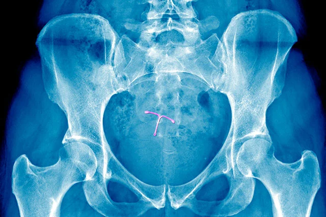An image of an IUD in an X-Ray of the cervix.