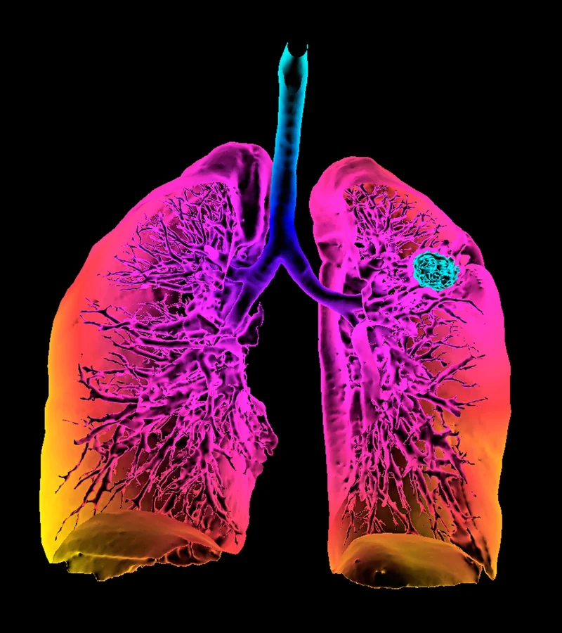 A colored 3D frontal computed tomography scan of human lungs highlighting a cancer lesion (blue) in the upper left lobe.
