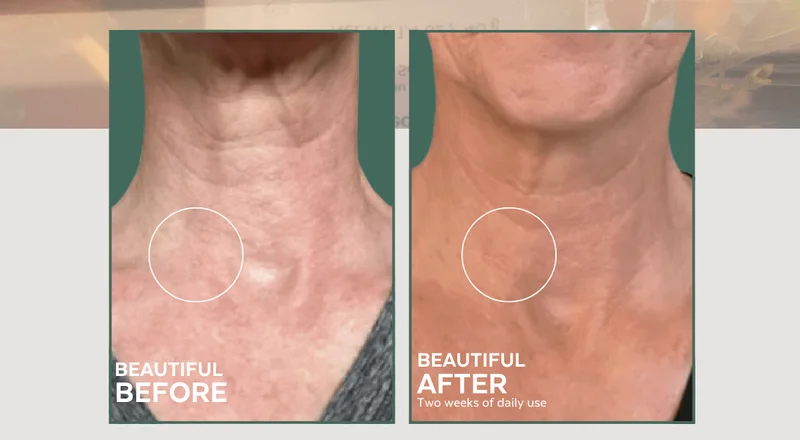 BEATUFIL BEFORE AND BEAUTIFUL AFTER *two weeks of daily use