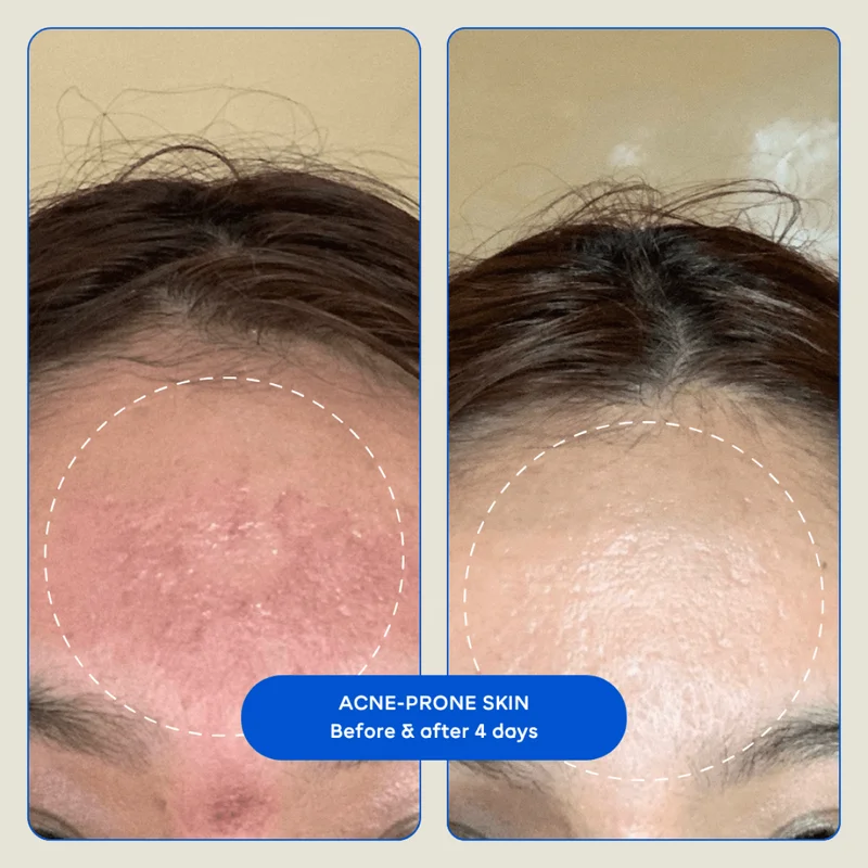 Reduction in acne before and after 4 days