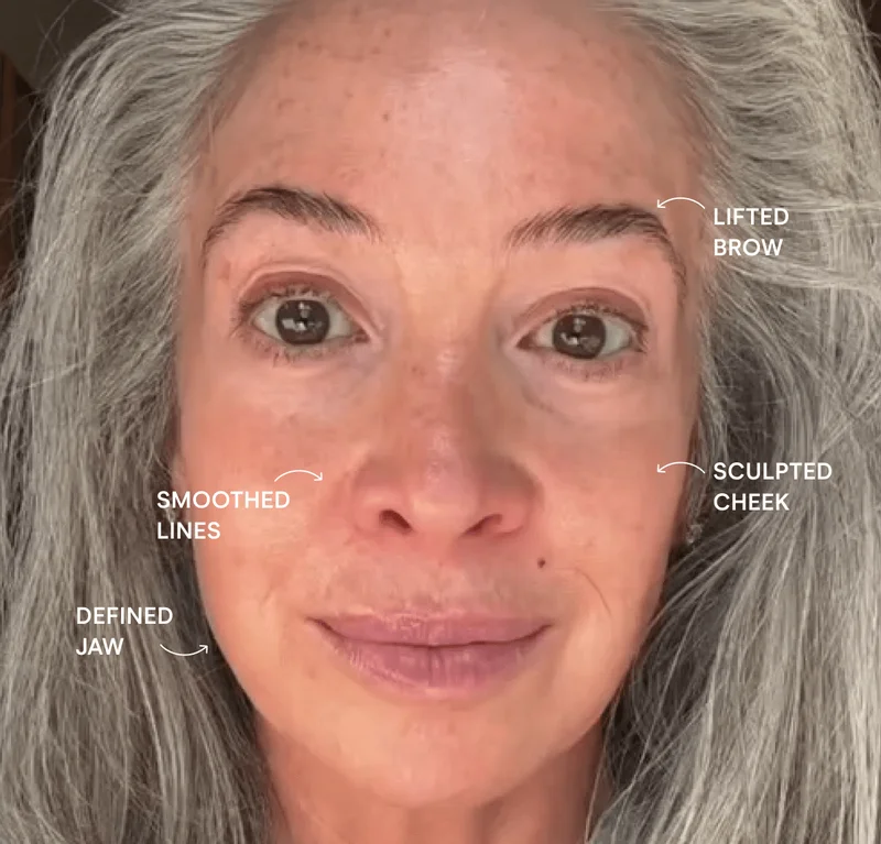 Lifted Brow | Smoothed Lines | Sculpted Cheek | Defined Jaw