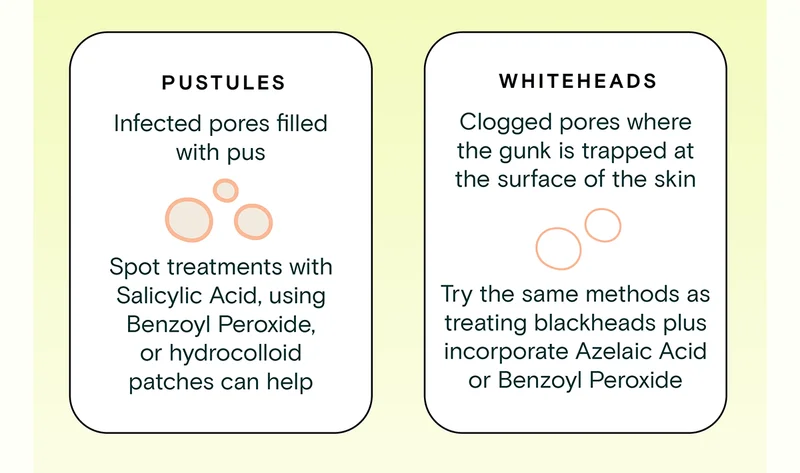 Pustules: Infected pores filled with pus. Spot treatments with Salicylic Acid, using Benzoyl Peroxide, or hydrocolloid patches can help. Whiteheads: Clogged pores where the gunk is trapped at the surface of the skin. Try the same methods as treating blackheads plus incorporate Azelaic Acid or Benzoyl Peroxide.