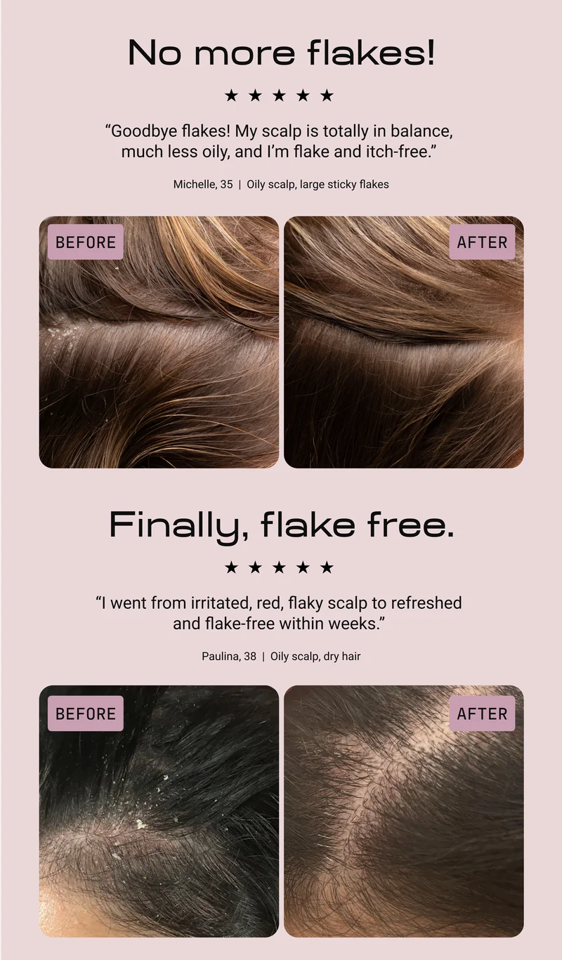 Two five-star customer before-and-after scalp photos. First, headline No more flakes, with Michelle, 35: Goodbye flakes, my scalp is totally in balance, much less oily, and I'm flake and itch-free. Second, headline Finally, flake free, with Paulina, 38: I went from irritated, red, flaky scalp to refreshed and flake-free within weeks. Both show clearer, flake-free scalps in the after photos.