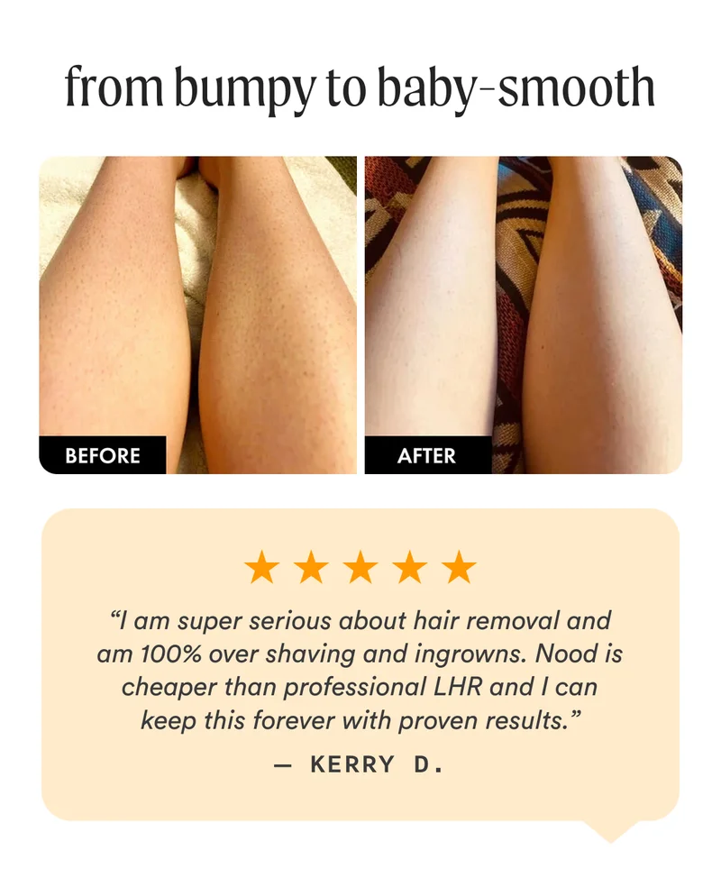 from bumpy to baby-smooth - Before & After Images - “I am super serious about hair removal and am 100% over shaving and ingrowns. Nood is cheaper than professional LHR and I can keep this forever with proven results.” — Kerry D.
