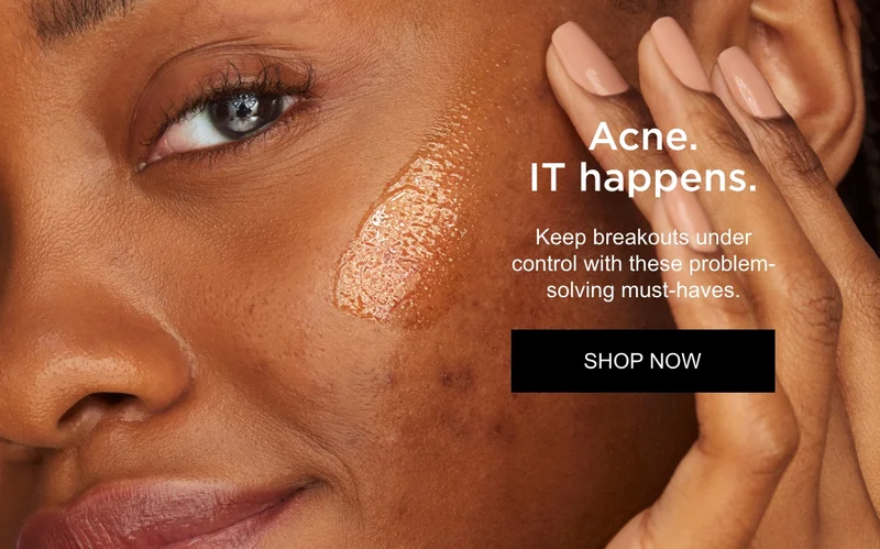 Acne. IT happens.