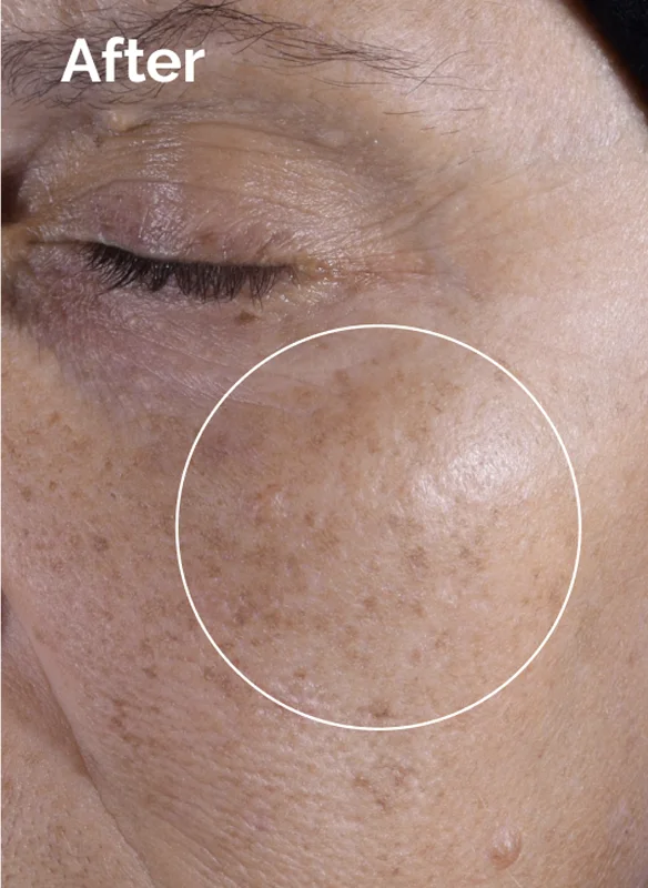 Explore the Before and Afrers of Glycolic Acid 7% Exfoliating Toner.
