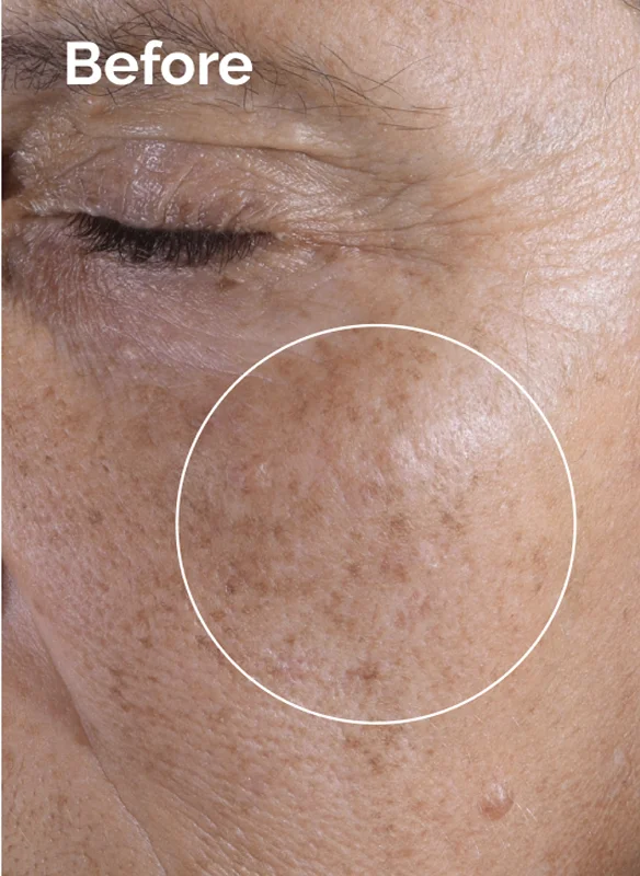 Explore the Before and Afrers of Glycolic Acid 7% Exfoliating Toner.