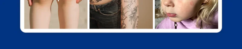 Eczema, cuts
