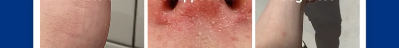 Blisters, bug bites