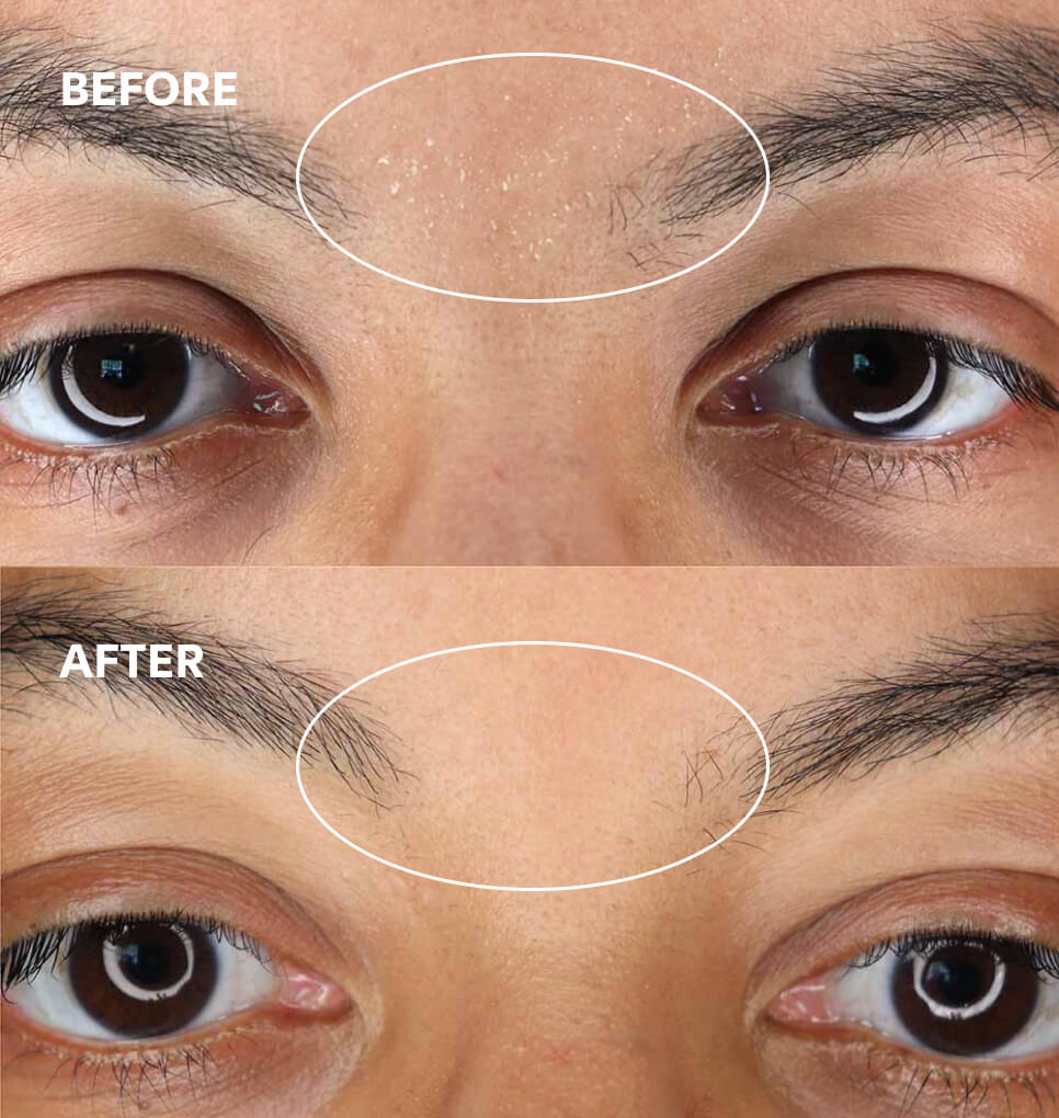 Before and After with woman's face showing pre- and post-exfoliation