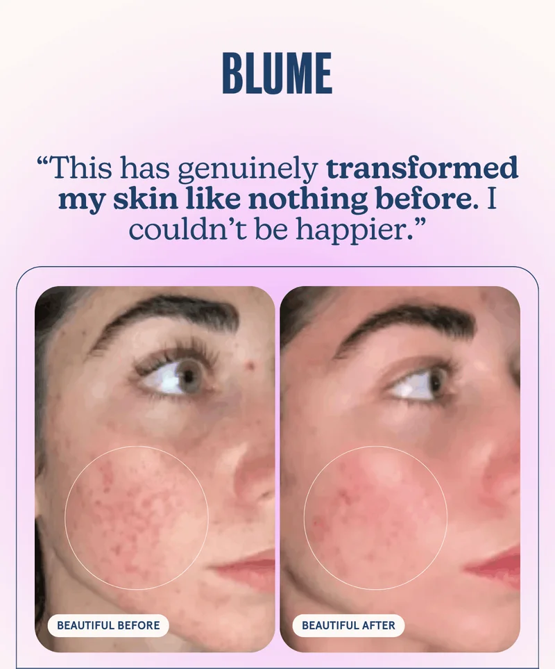BLUME: “This has genuinely transformed my skin like nothing before. I couldn’t be happier.”
