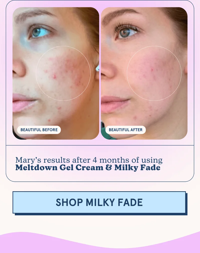 Mary’s results after 4 months of using Meltdown Gel Cream & Milky Fade [SHOP MILKY FADE]