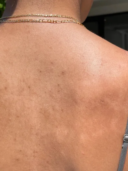 Dry skin