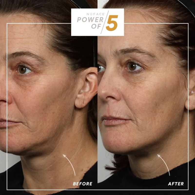 Before and After treatment results using NuFACE microcurrent skincare