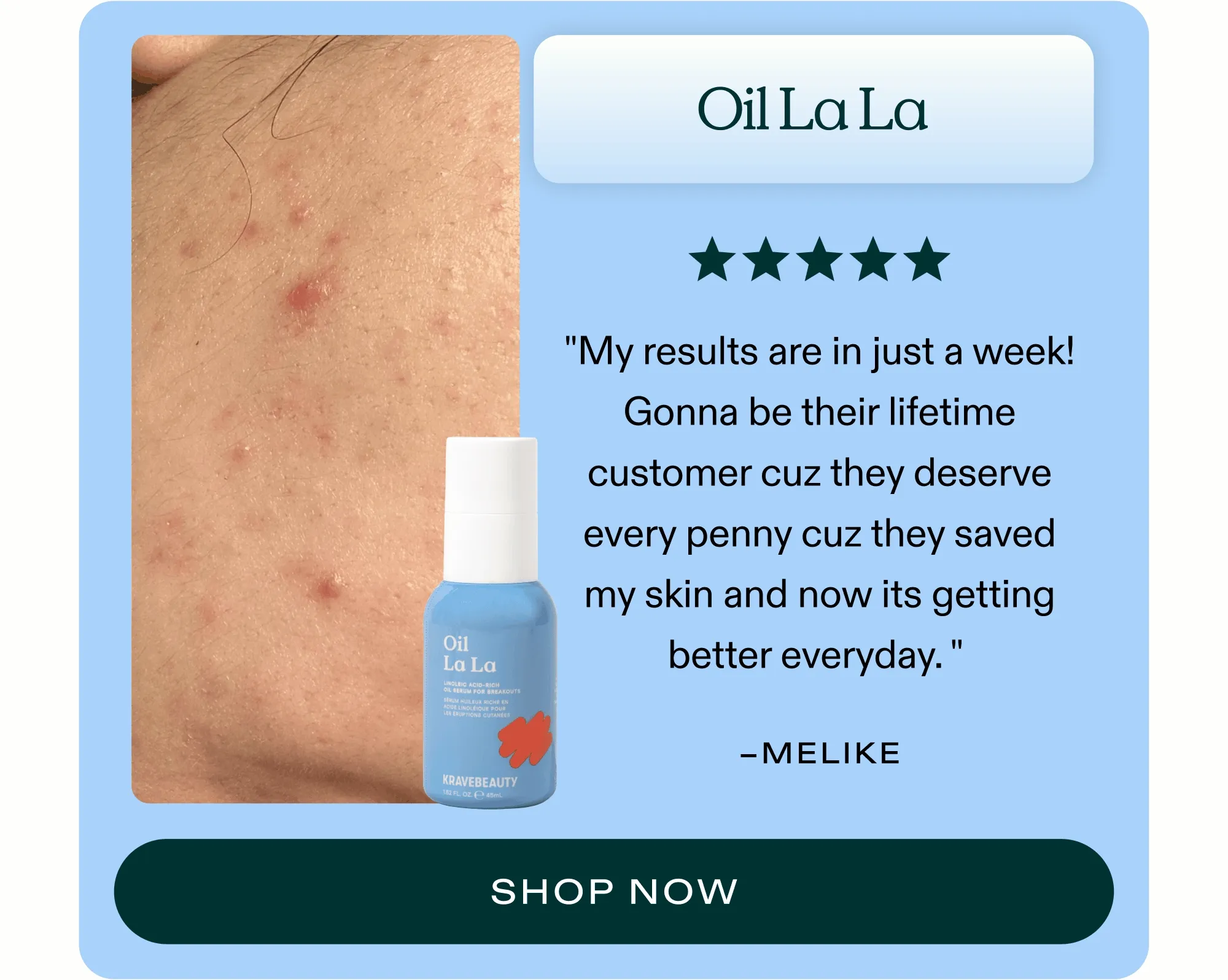 Oil La La ⭐⭐⭐⭐⭐ "My ride or die product! This oil has changed my skin. It’s so lightweight and keeps my pores clean and skin acne free!" - Maddie  |  SHOP NOW