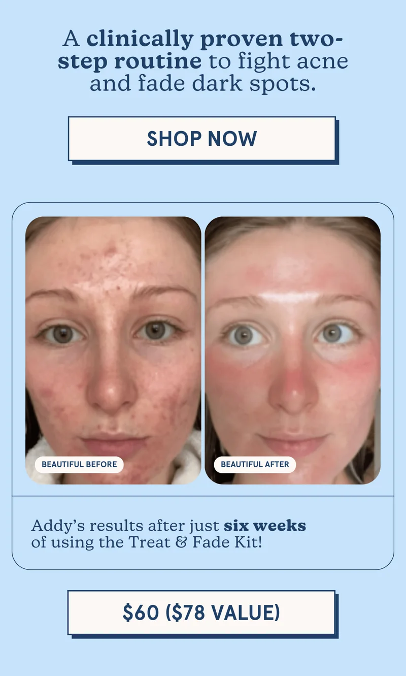 A clinically proven two-step routine to fight acne and fade dark spots [$60, $78 value!]