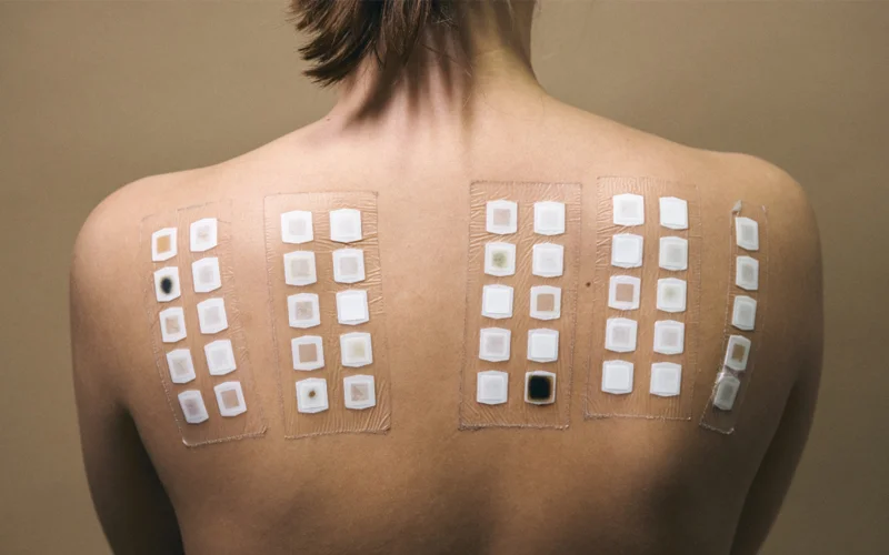 A woman’s back is covered in allergen patches for atopy patch testing (APT), which is one way to determine if a food is actually causing an allergic reaction.