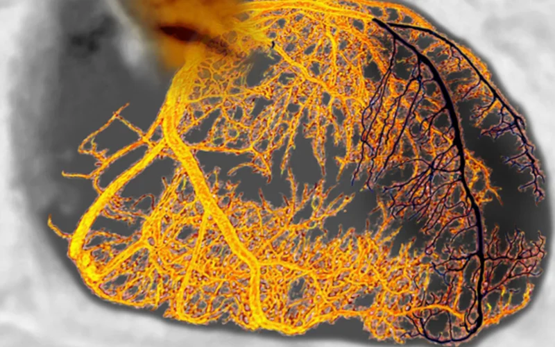 The holiday season is associated with an increase in both cardiac arrhythmias and heart attacks. Here, a colorized angiogram reveals a blockage of the left coronary artery (black), which led to a heart attack.