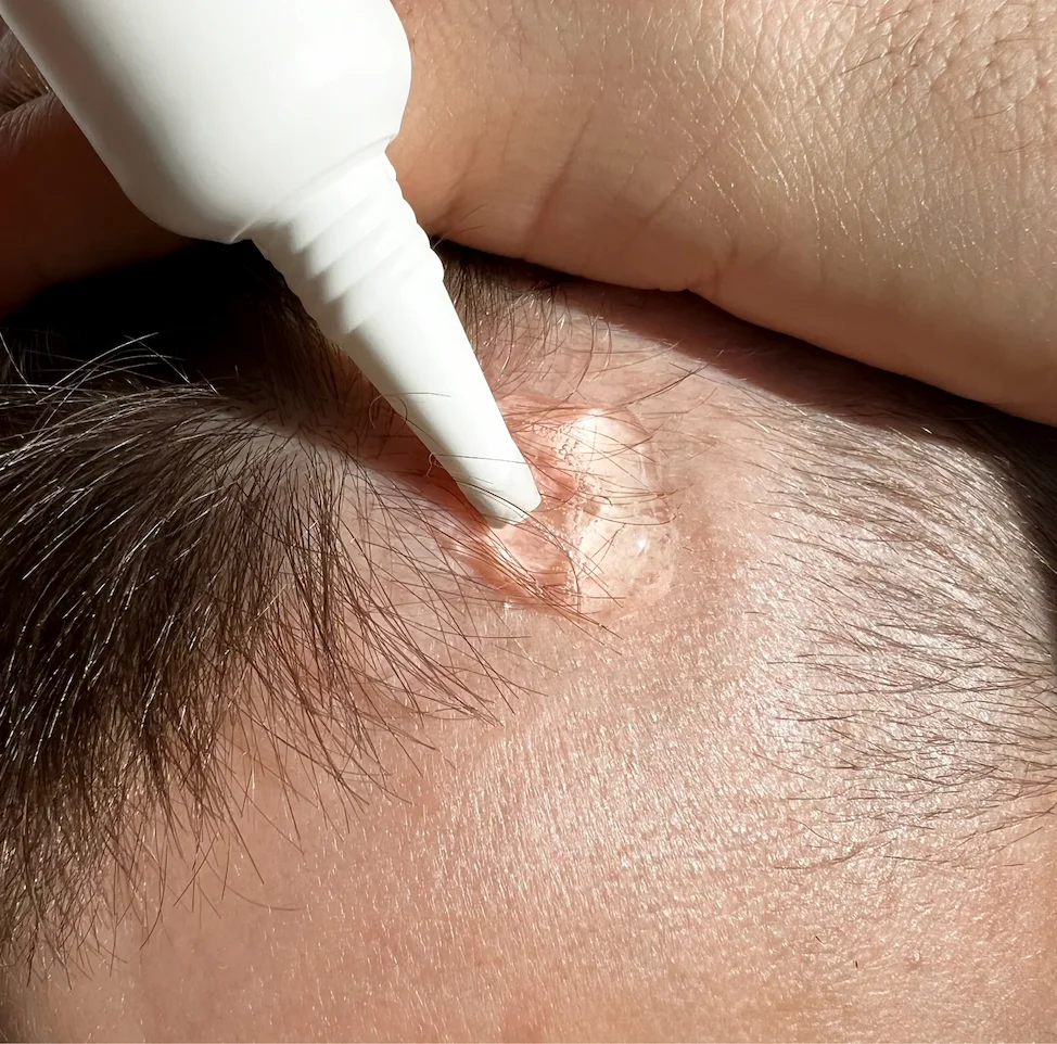 Hair Growth Kit in use