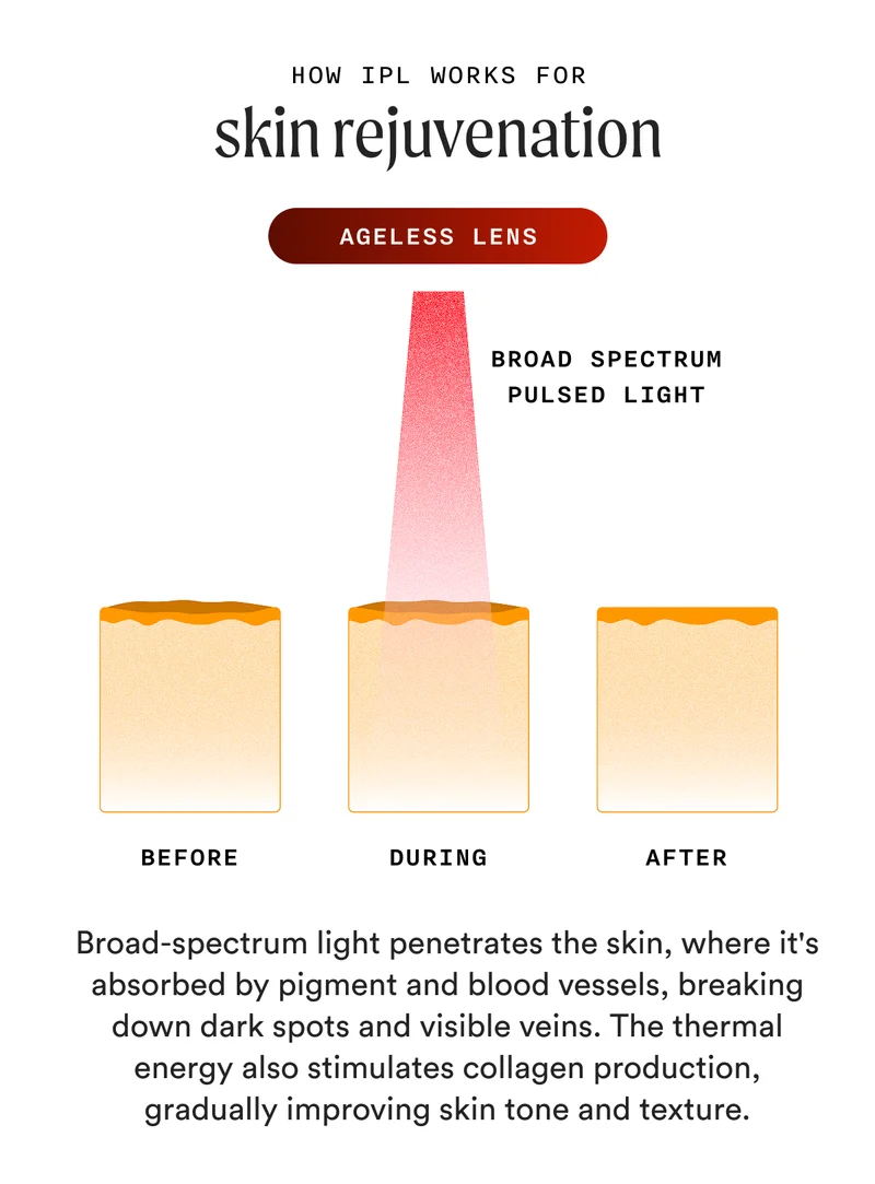 How IPL Works For skin rejuvenation (Ageless Lens) - Broad-spectrum light penetrates the skin, where it's absorbed by pigment and blood vessels, breaking down dark spots and visible veins. The thermal energy also stimulates collagen production, gradually improving skin tone and texture.