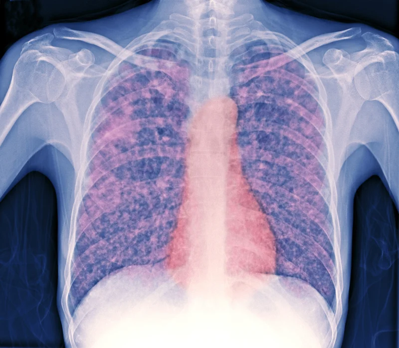 A colorized X-ray of a patient's chest shows lesions (tubercles, pink) caused by tuberculosis (TB) consisting of infected dead tissue. Treatment for the highly contagious disease requires consistent taking antibiotics for several months.