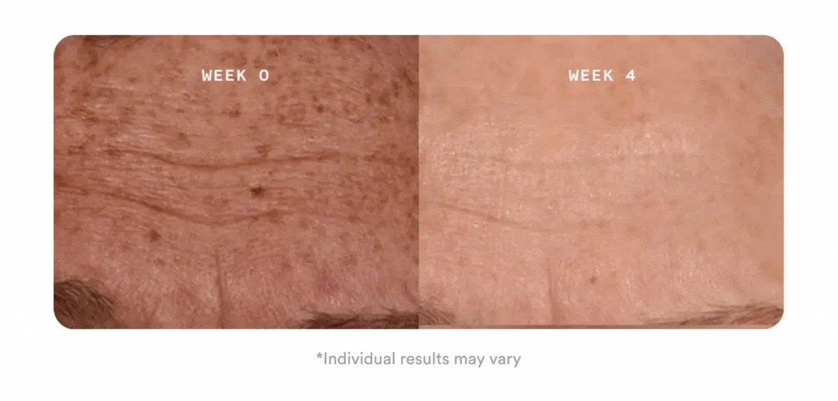 The Flasher Pro Ageless Lens Before & After Results